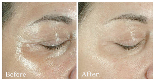 นวัตกรรมล่าสุดของการยกกระชับผิว ลดเลือนริ้วรอย สัมผัสผลลัพธ์เร่งด่วนภายใน 10 นาที!!!